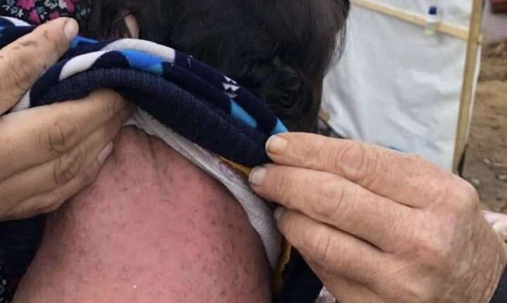 الفشل الكلوي